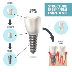 Dental Implants Perth