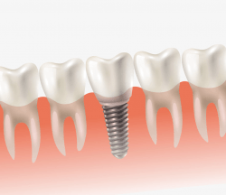 Dental Implants Perth Tooth
