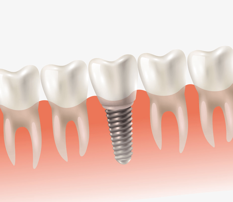 Dental-Implant Dentist Cost