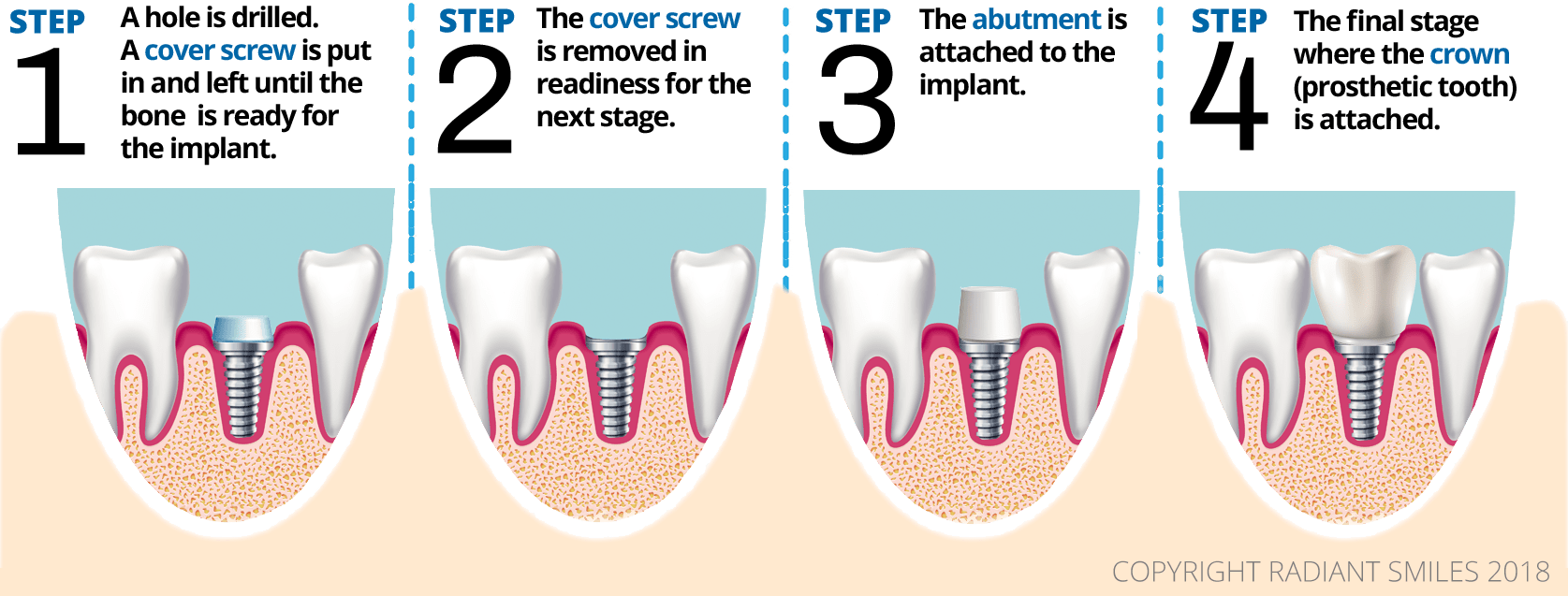 Dental Implants Perth Definition Process Explained Dental Implants Process Explained