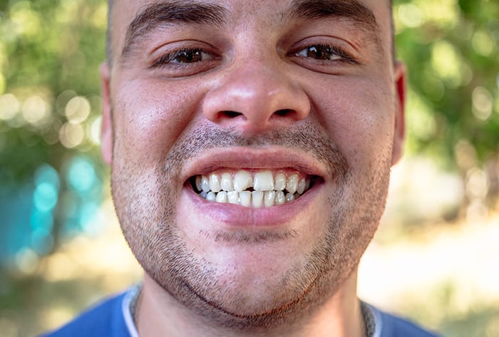 Are Fruits Bad for Your Teeth?