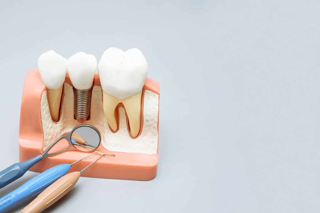 Artificial teeth with bone grafting Bone Grafting in Perth WA