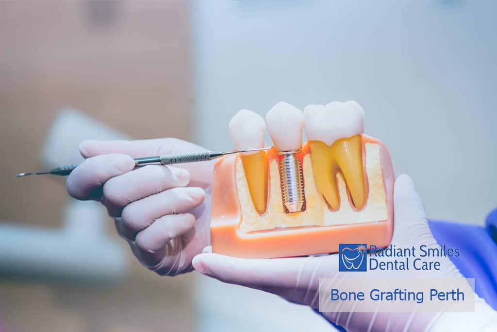 Dental bone graft Perth's bone grafting for implants
