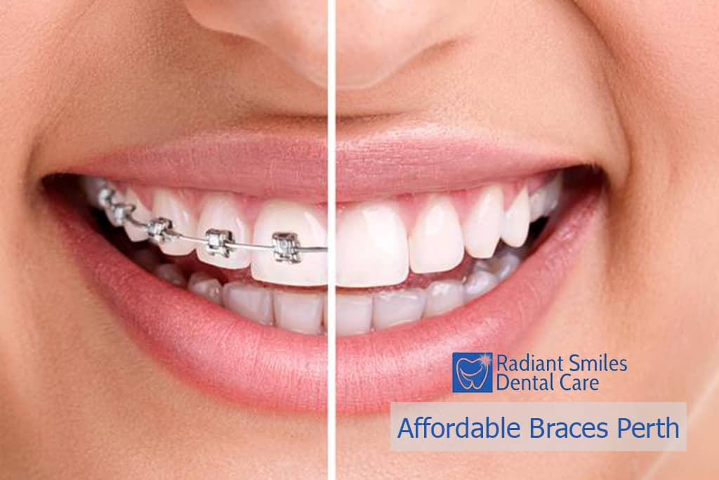 Affordable braces Perth