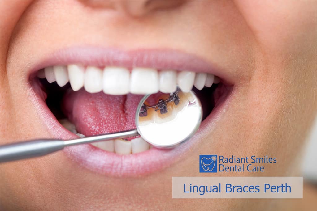 Lingual braces Perth
