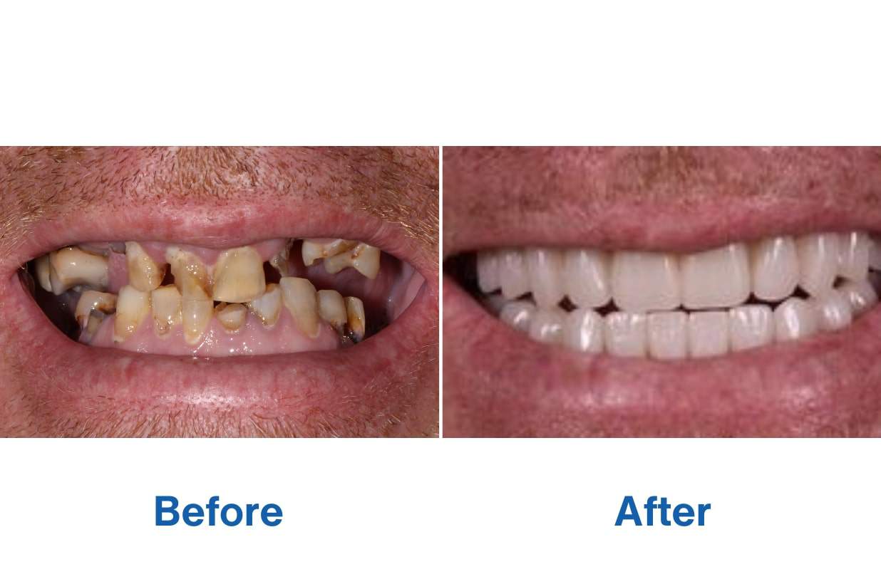 Before and After Complete Smile Makeover with Perth Dental Implants Before and After Complete Smile Makeover with Full Dental Implants