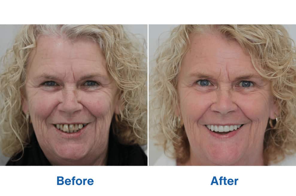 Before and After Dental Implants Perth – Patient Kim Smile Makeover Before and After Dental Implants Perth - Patient Kim Smile Makeover - Tooth Replacement Procedure
