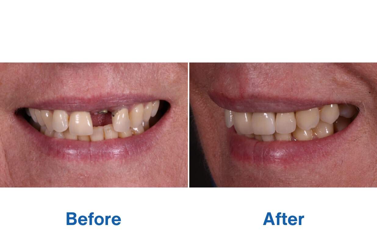 Before and After Patient Smile with Dental Implants Before and After Patient Smile with Dental Implants - Teeth Replacement Perth