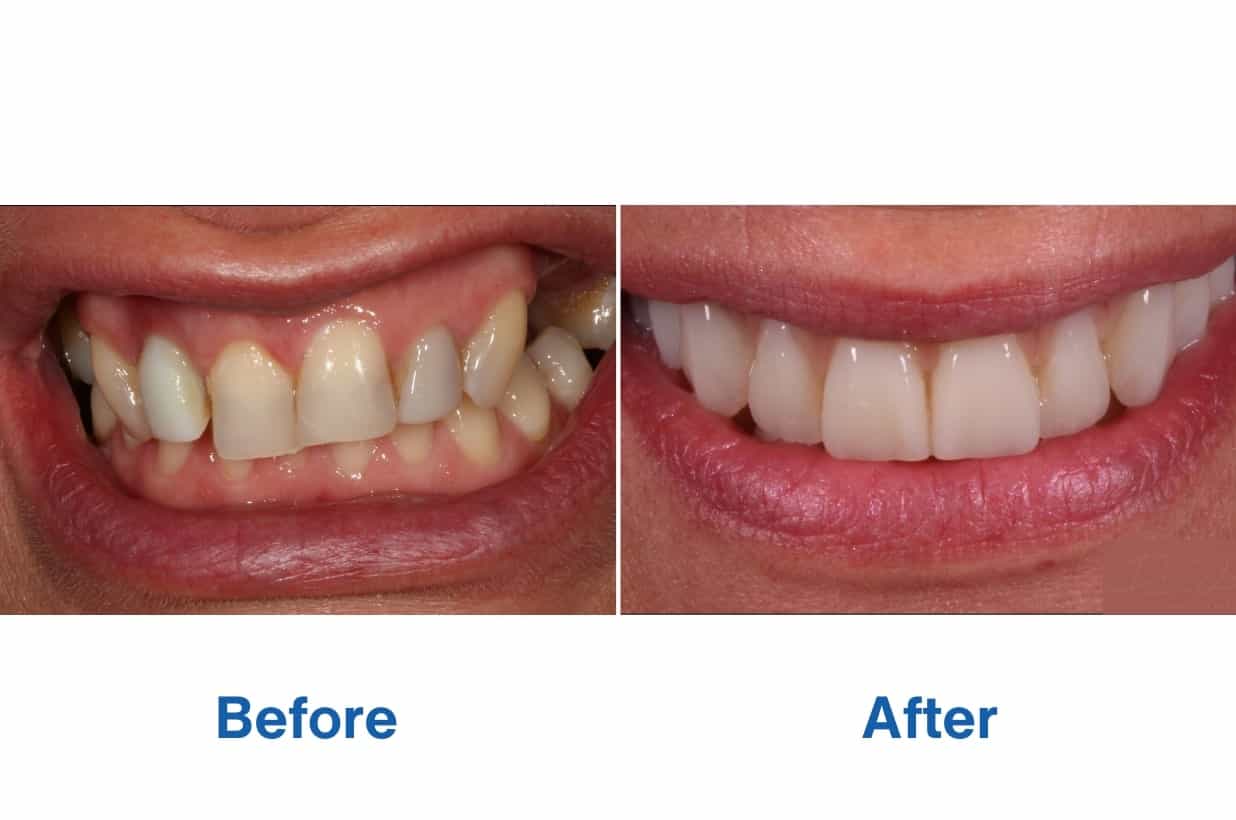 Before and After Photos of Patient in Smile Makeover Journey – Dental Implants Perth Before and After Photos of Patient in Smile Makeover Journey - Dental Implants Perth - Teeth Replacement