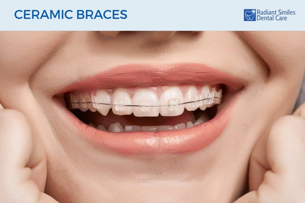 Ceramic Braces in Albany