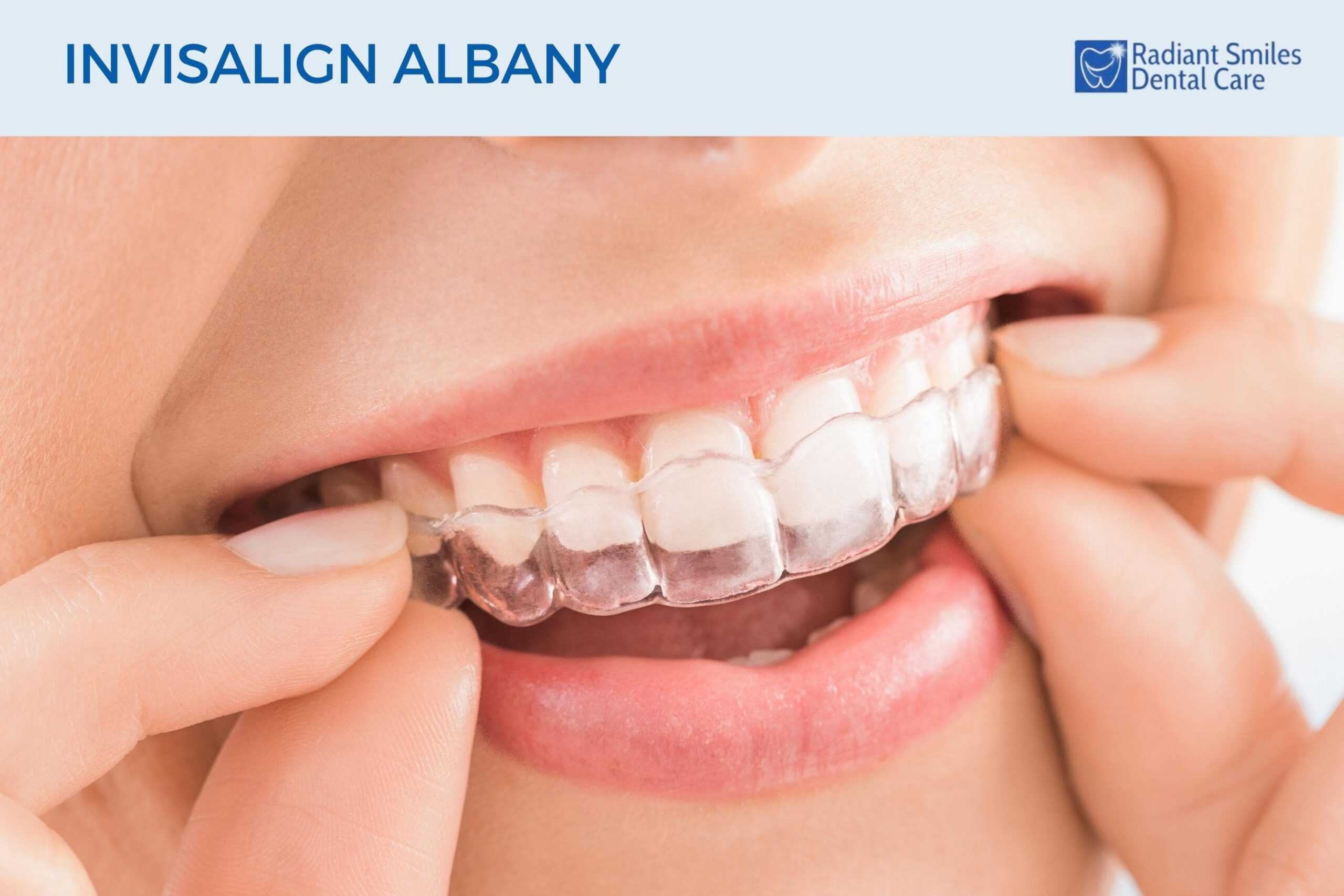 Invisalign Albany - Clear Aligners Invisalign Albany - Clear Aligners
