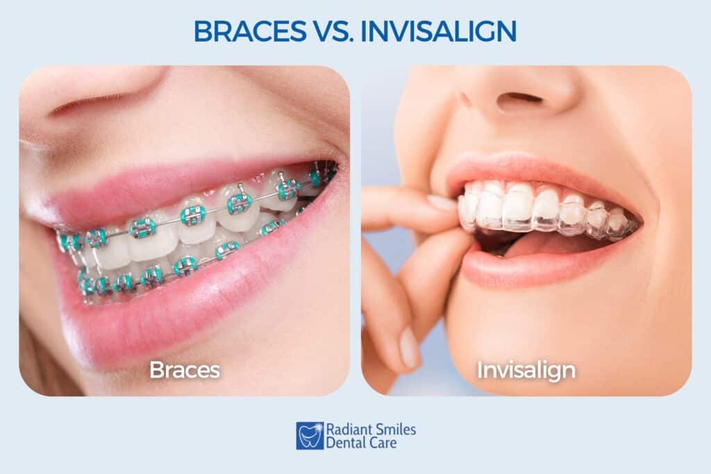 Invisalign Clear Braces