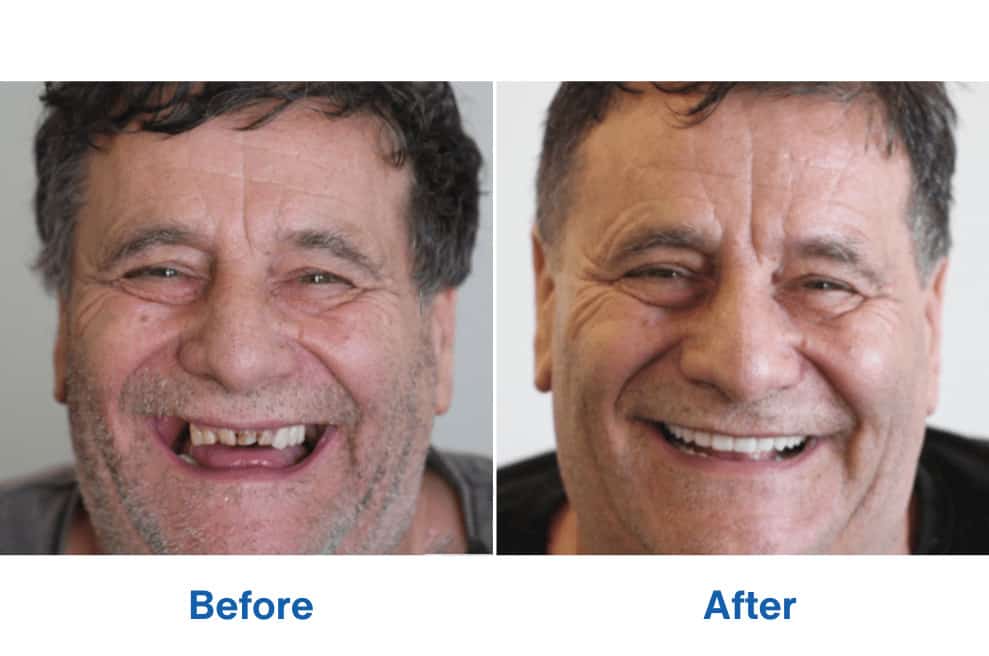 Patient Frank Before and After Dental Implants Perth – Smile Makeover Patient Frank Before and After Teeth Implants Perth - Smile Makeover
