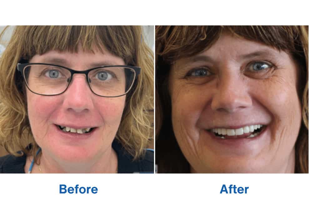 Patient Lara Before and After Perth Dental Treatment Patient Lara Before and After Dental Treatment with Implant Dentist Perth