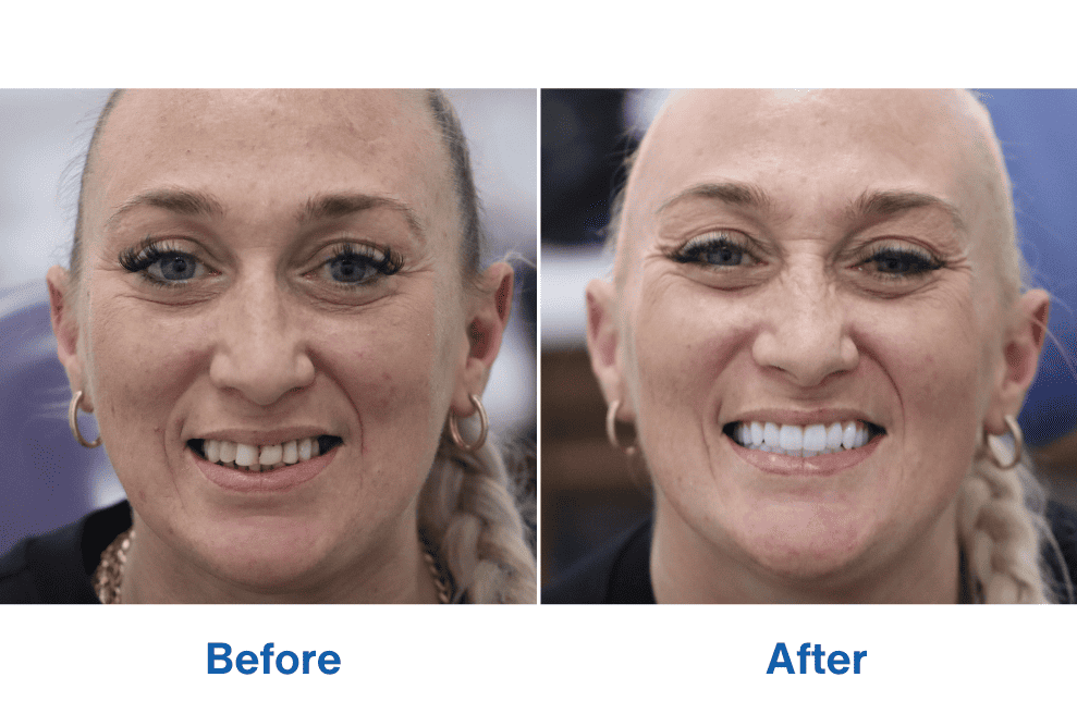 Patient Sarah Before and After Smile Restoration After Tooth Implants Procedure Patient Sarah Before and After Smile Restoration After Tooth Implants Procedure