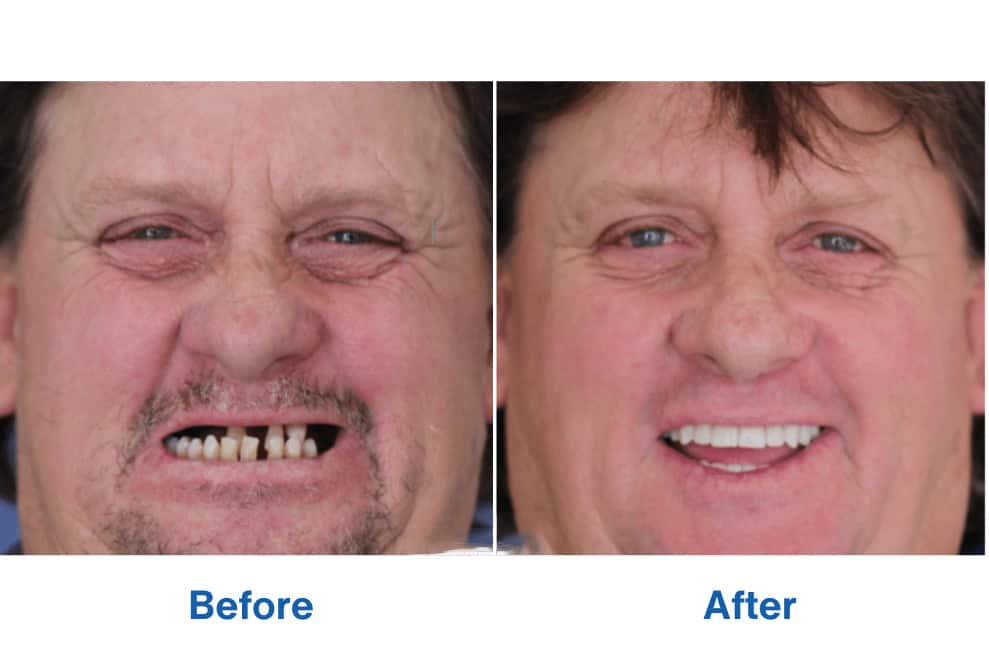 Patient Will – Before and After Smiles – Dental Implants in Perth Patient Will - Before and After Smiles - Affordable Dental Implants in Perth