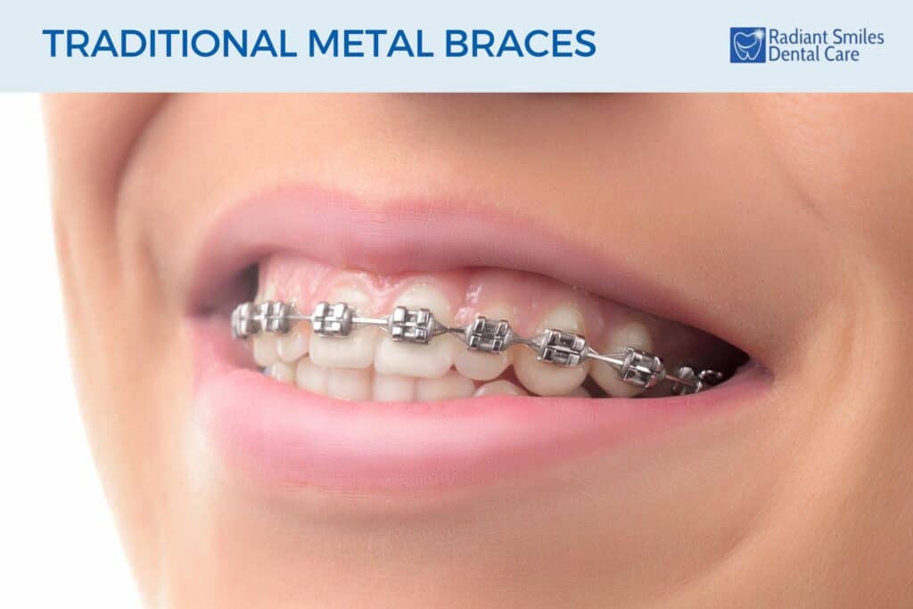 Traditional Metal Braces in Albany