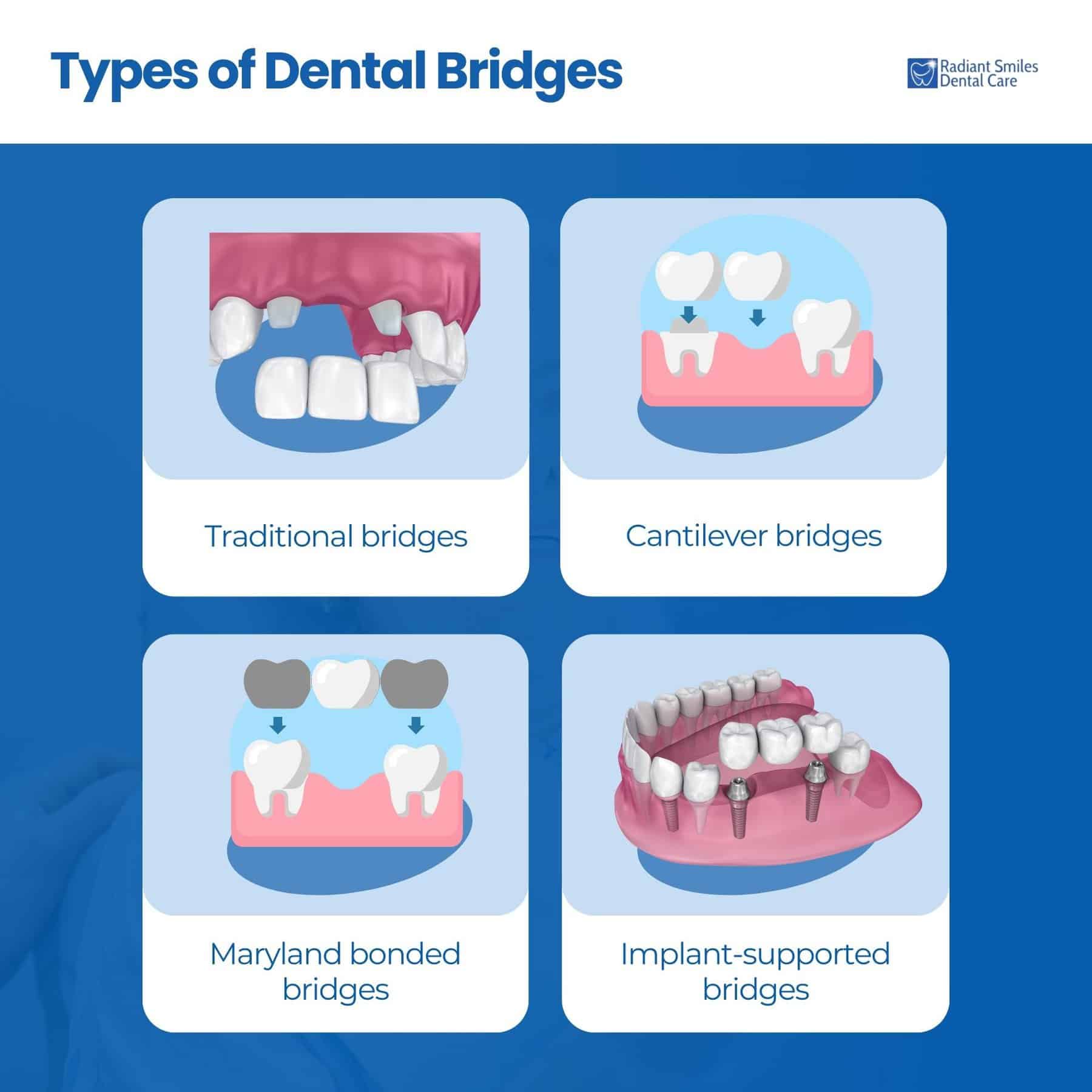 Types of Dental Bridges - m Types of Dental Bridges