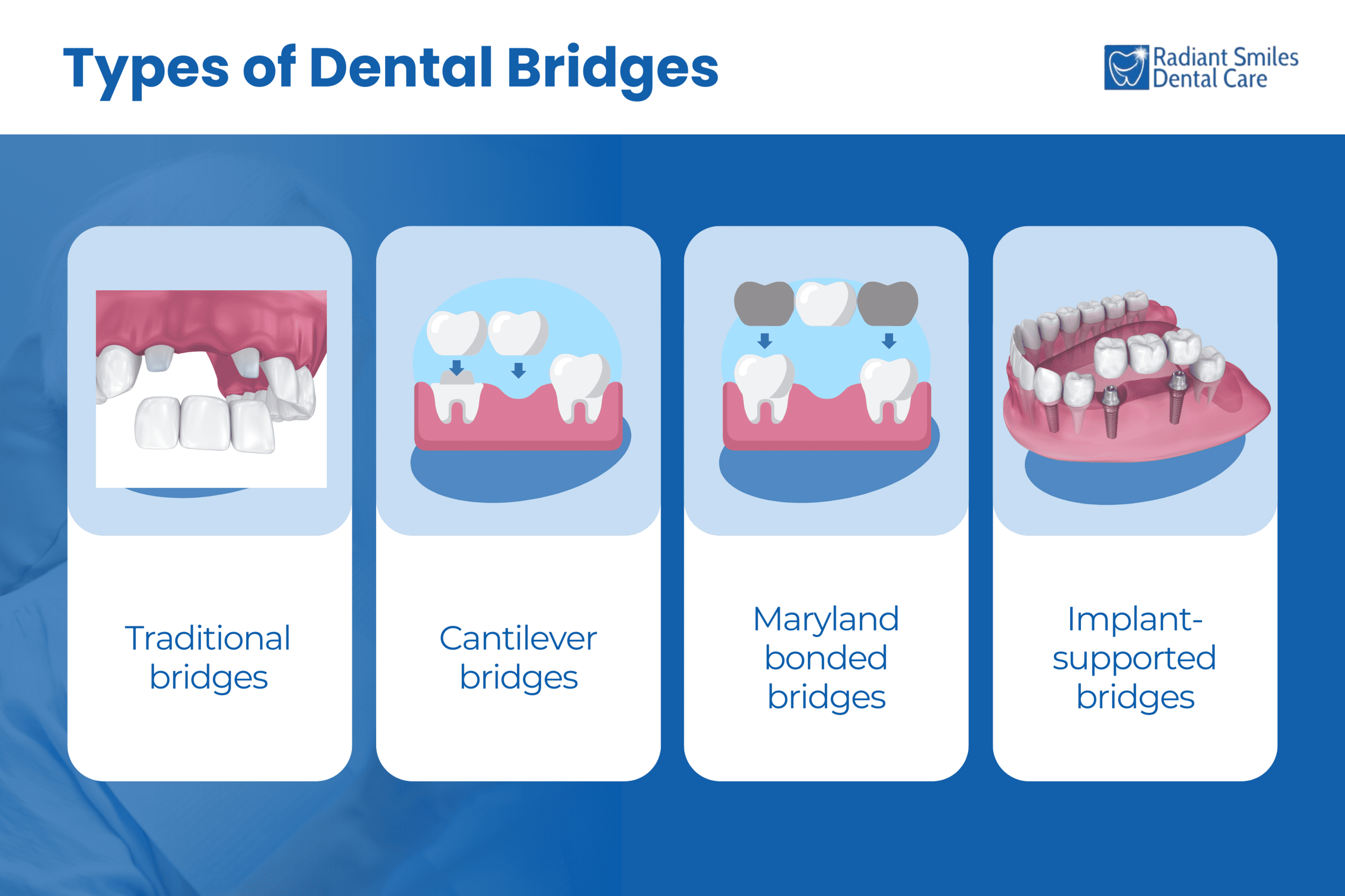 Types of Dental Bridges Types of Dental Bridges