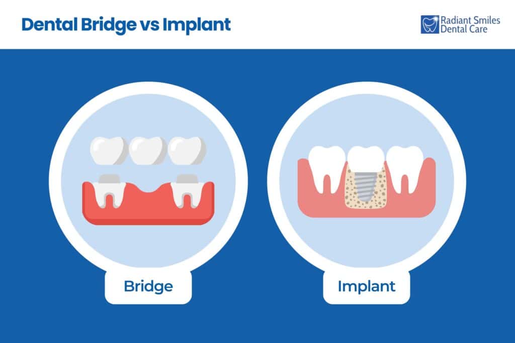 dental bridge vs implant comparison