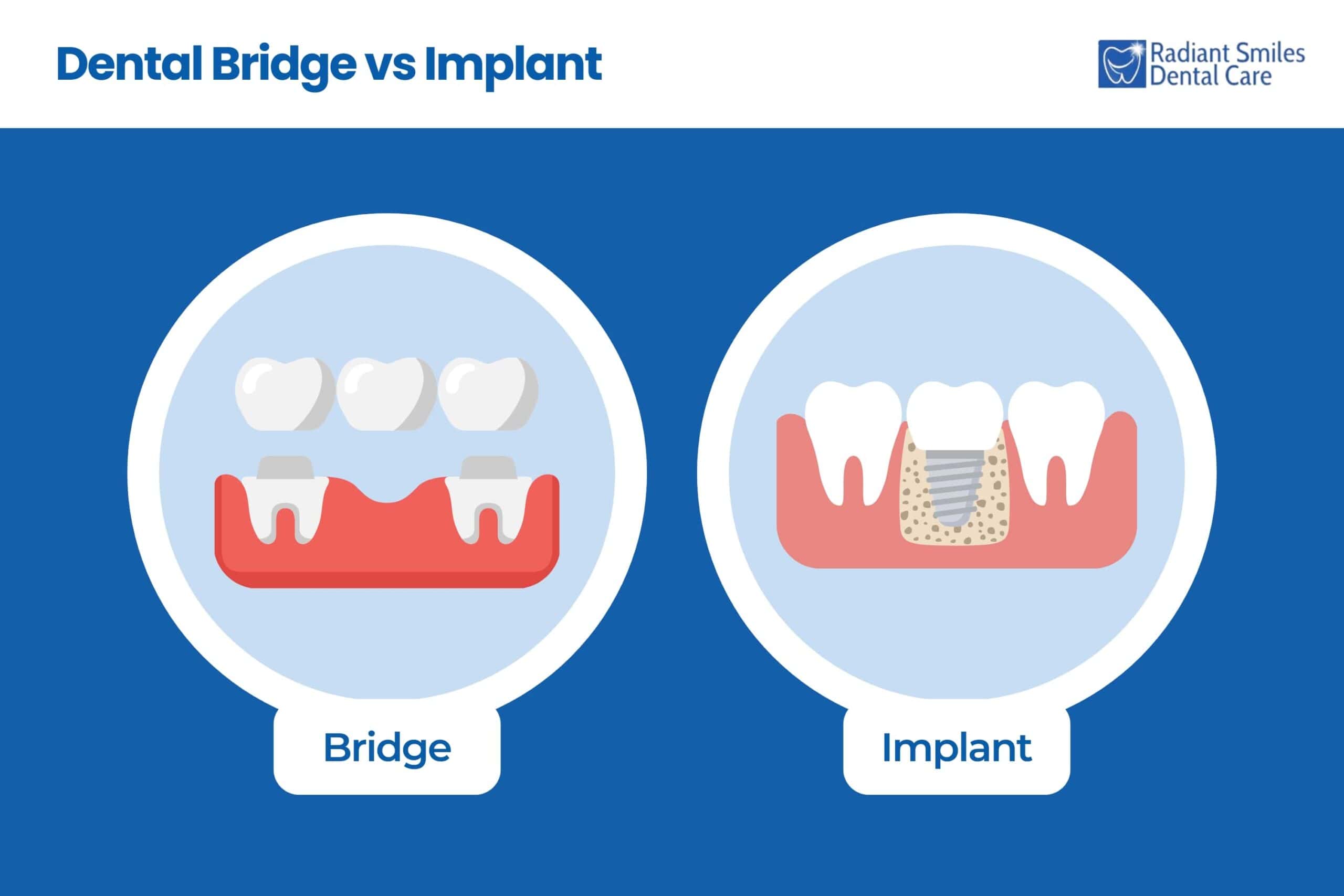 dental bridge vs implant comparison