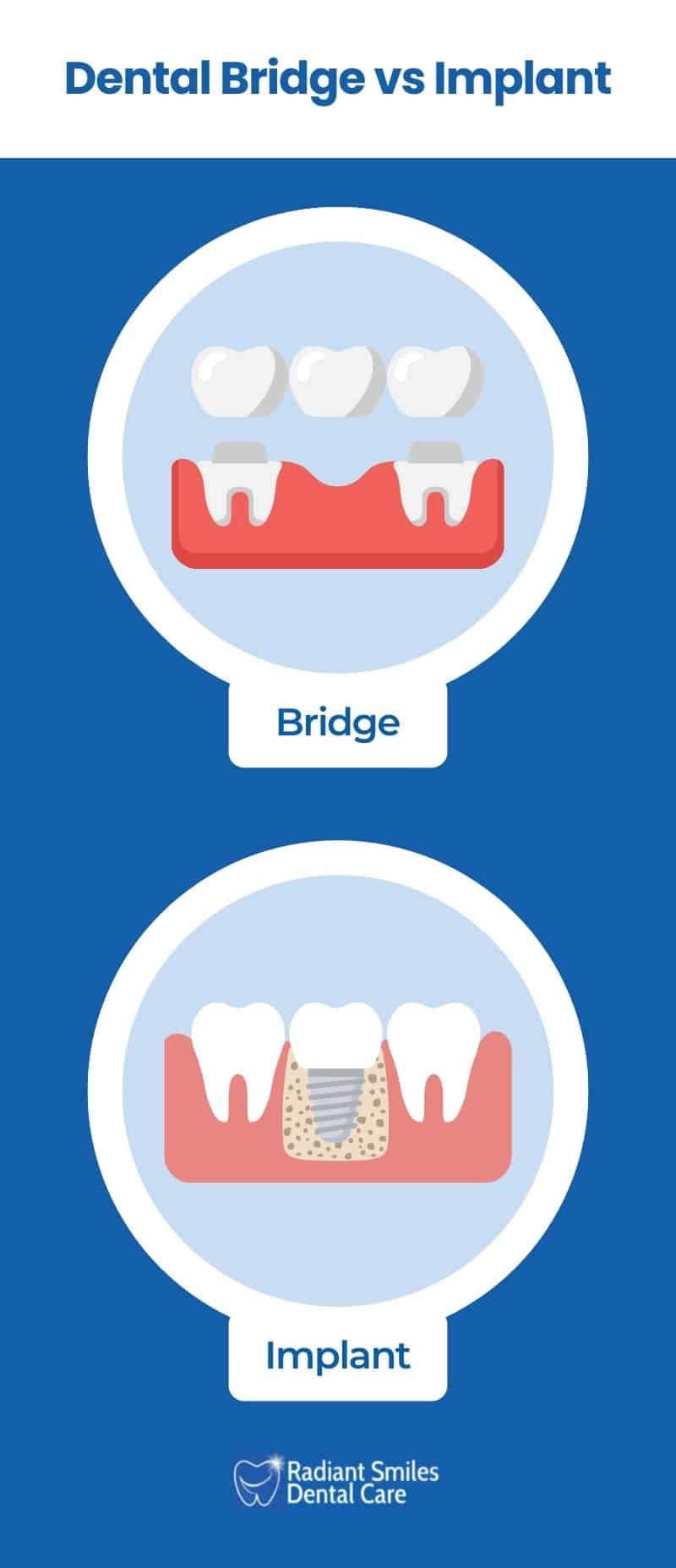 dental bridge vs implants