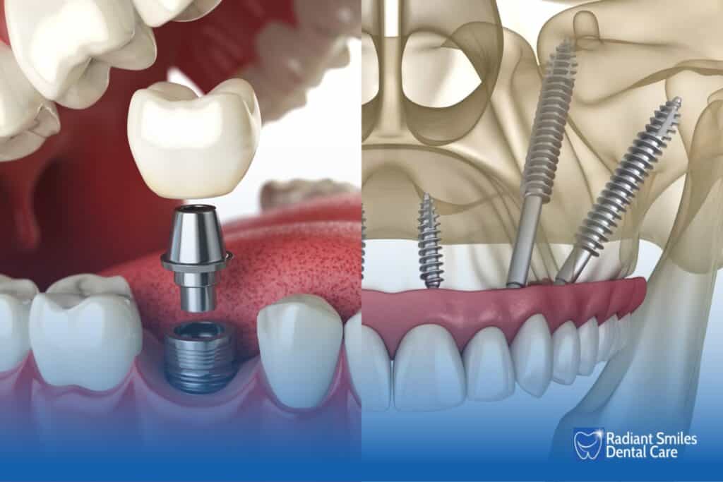 how are zygomatic dental implants different from regular dental implants