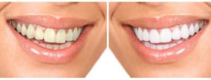 teeth whitening albany before after patient smile
