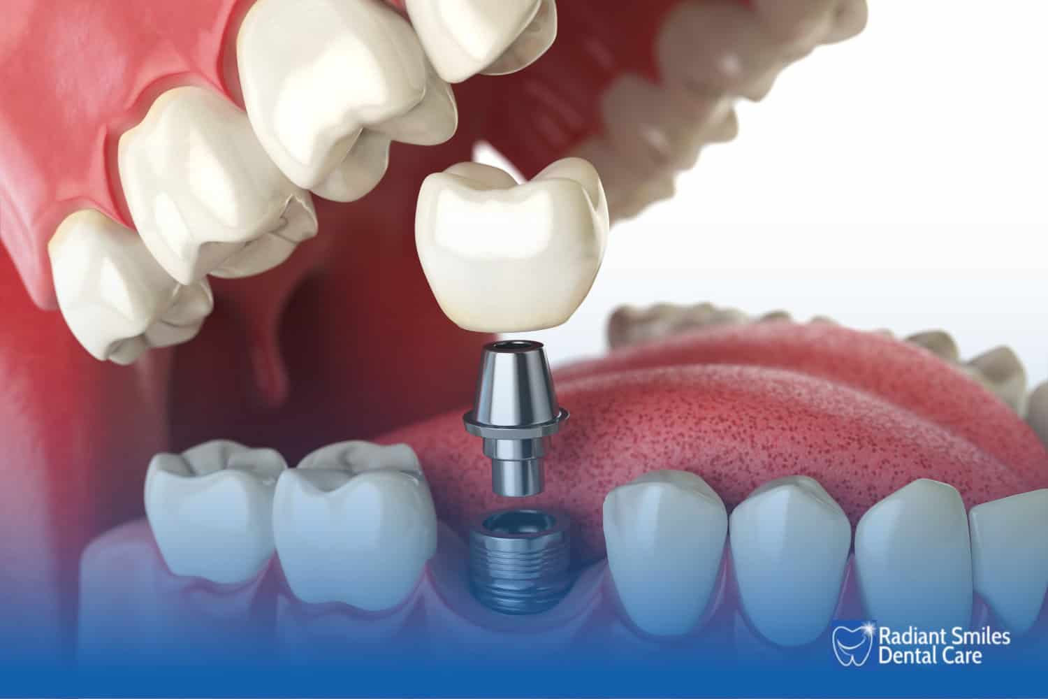what are screwless dental implants