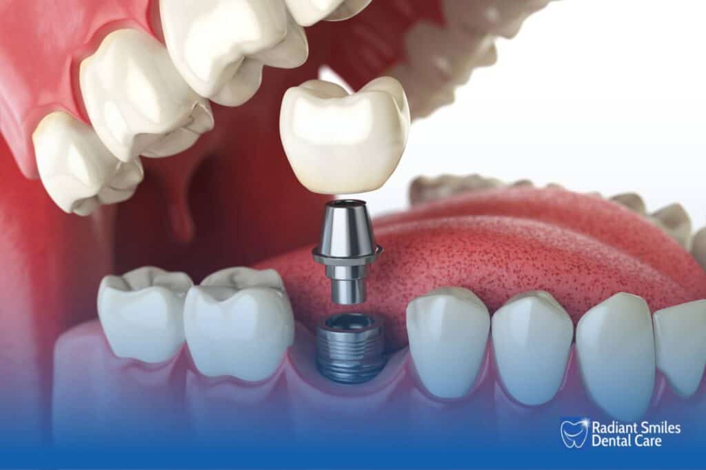 what are the common causes of pain associated with dental implants 