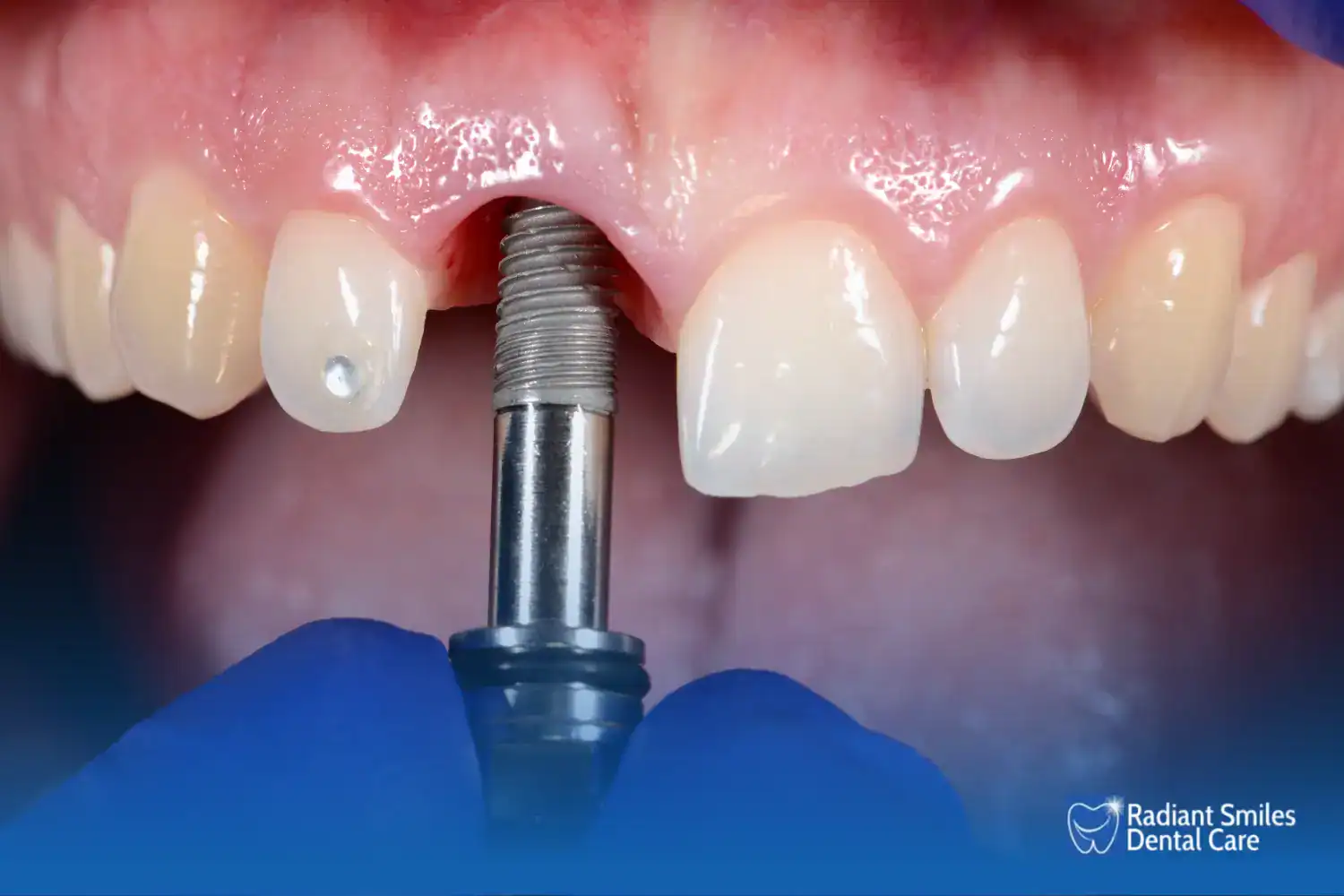 what are these one day implants all about