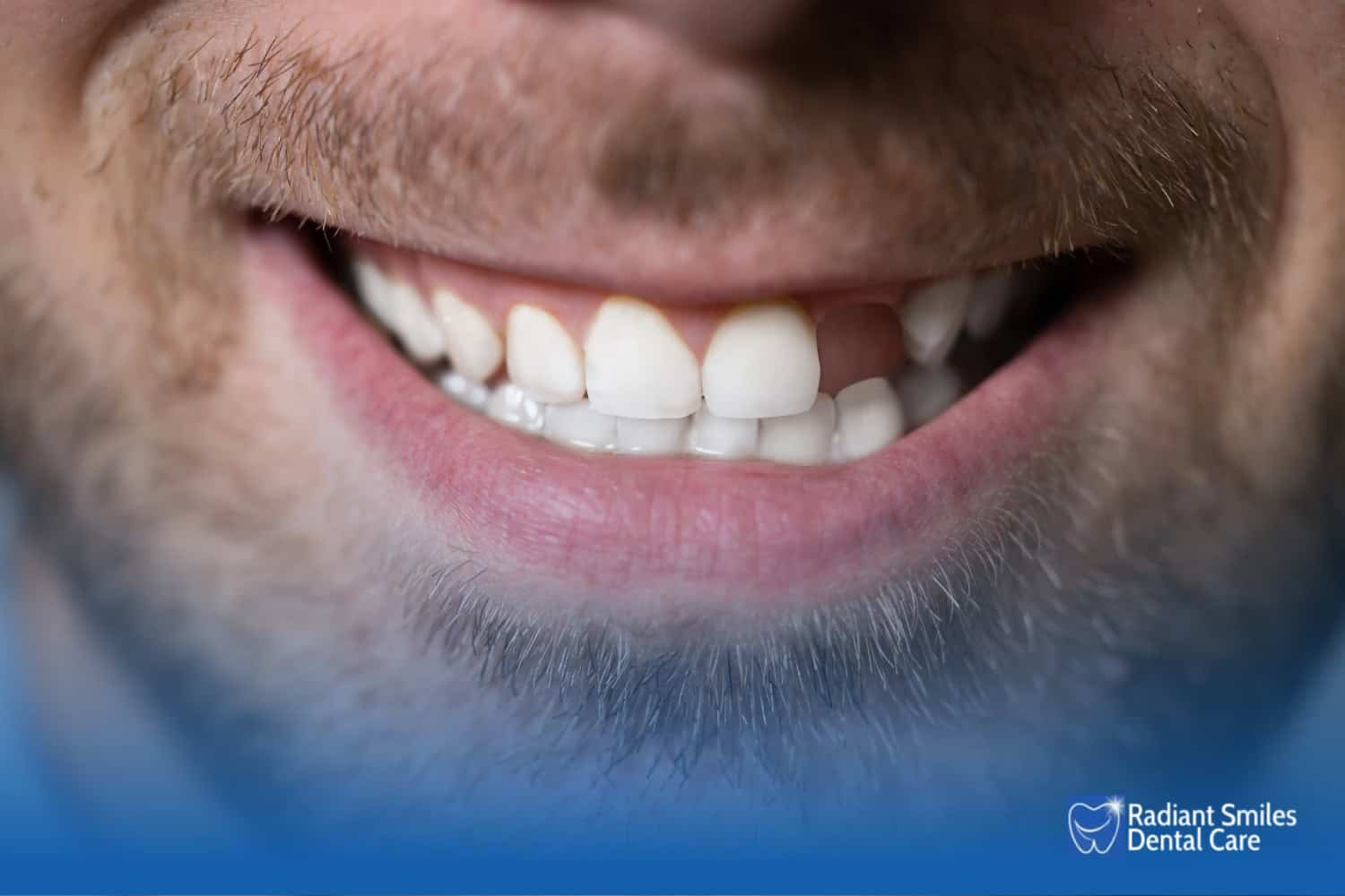 why should you replace a missing tooth